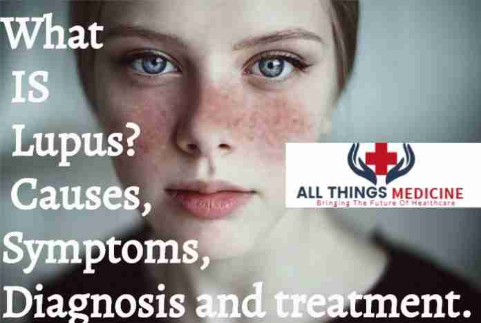 What is lupus and what causes it